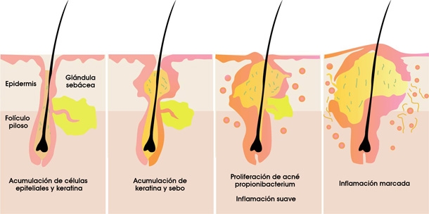 Evolución del acné