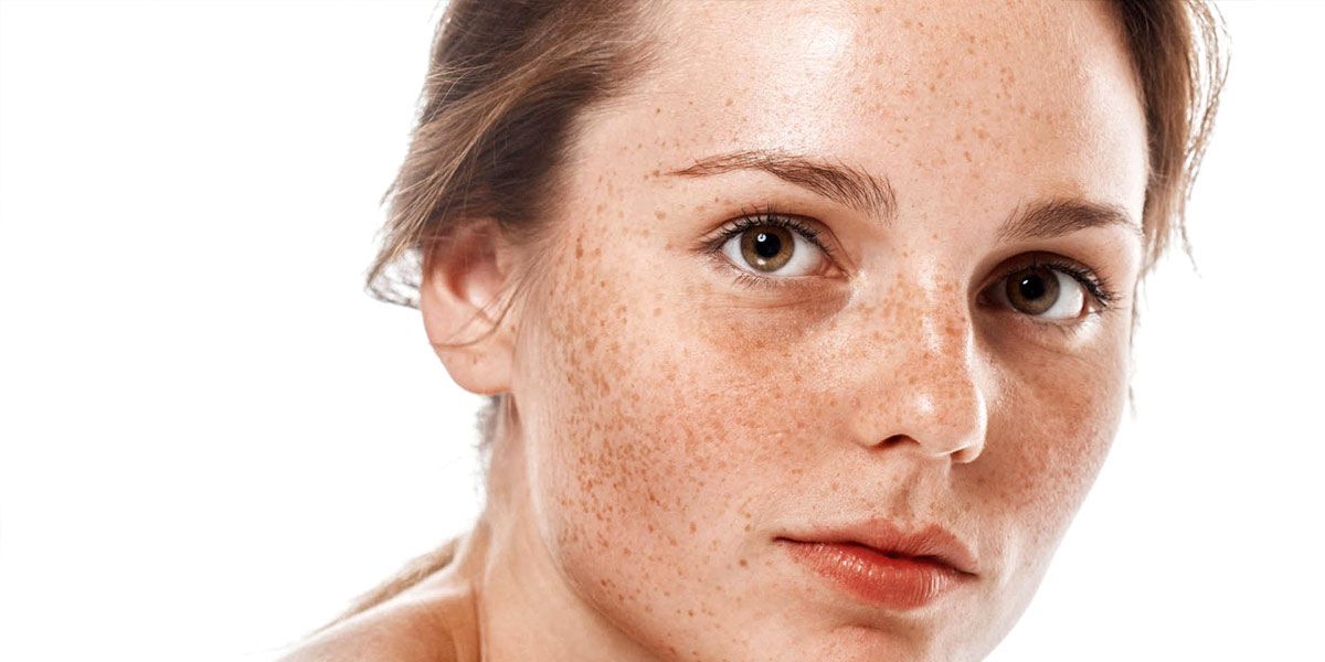 Tratamiento facial antimanchas — Eliminar melasma e hiperpigmentación