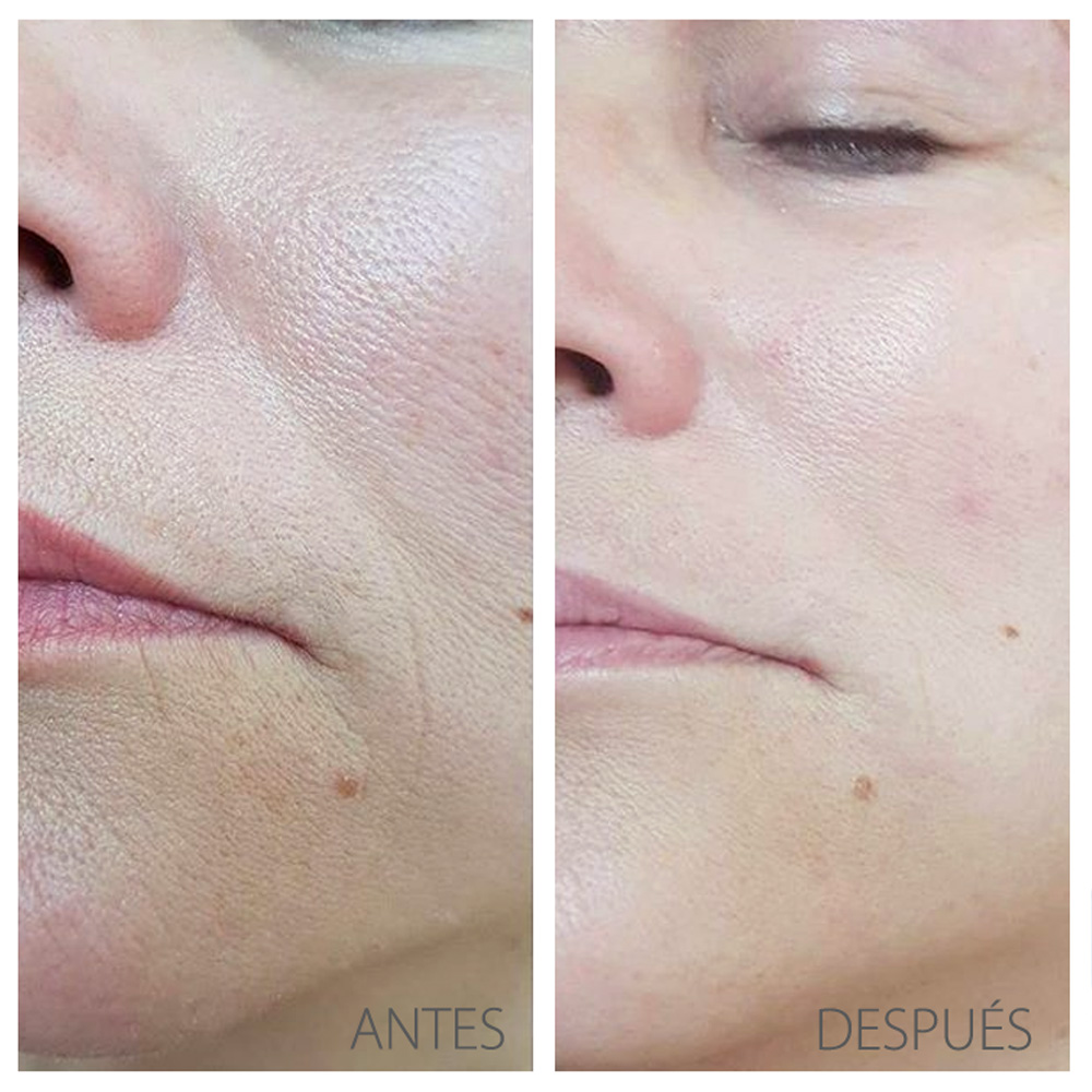 HYDRO-JETPEEL — La piel se purifica y oxigena