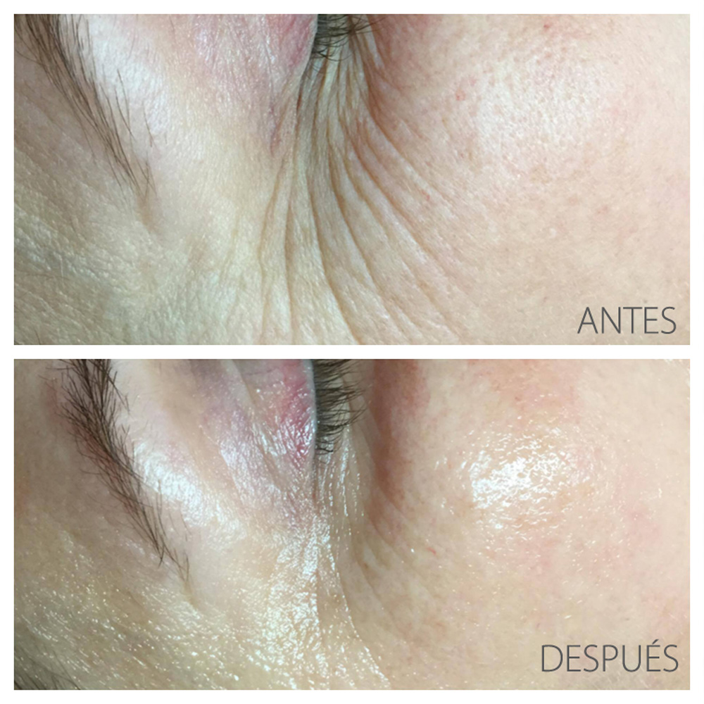 HYDRO-JETPEEL — Sin cirugía, sin inyecciones, sin abrasión