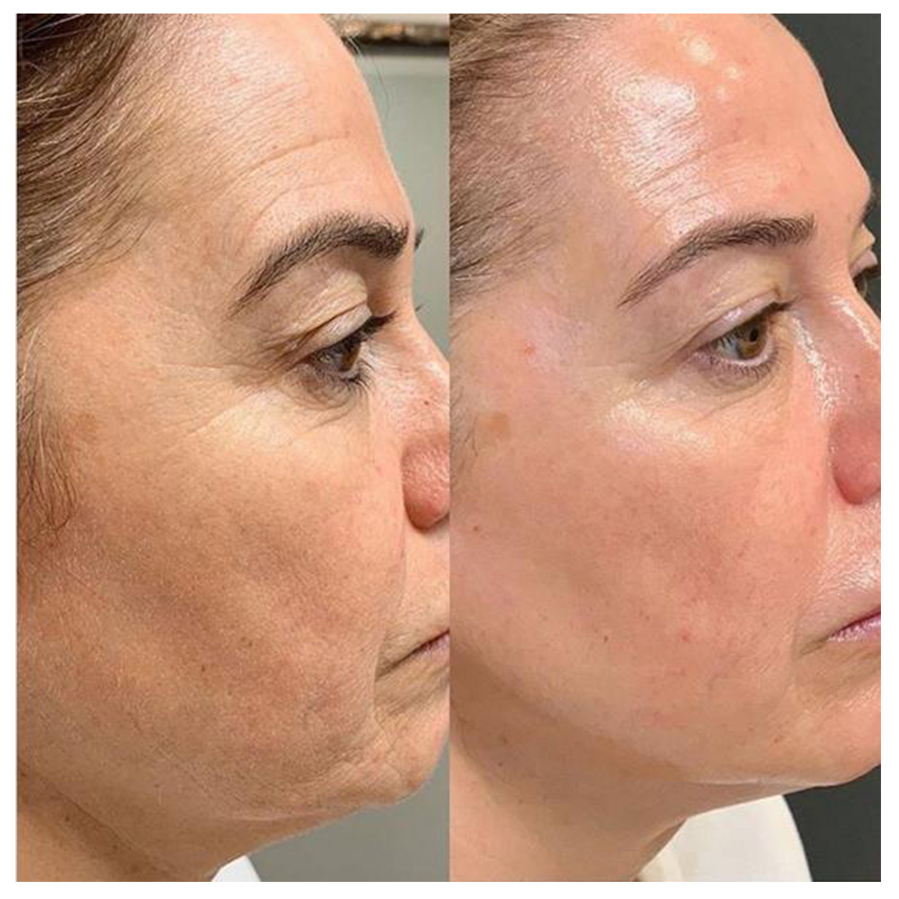 JETPEEL Oxygen — Perfecto para cara, mentón, cuello, escote y manos