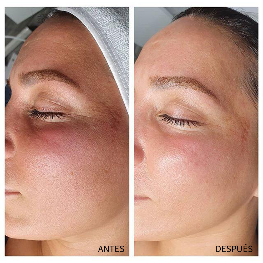 JETPEEL Oxygen™ — Hidrata en profundidad la piel